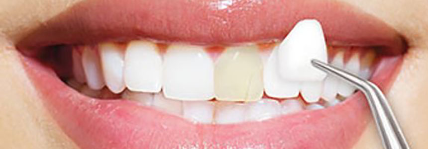 porcelian-veneers