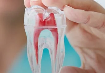 Root Canal Treatment